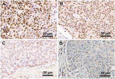 Prognostic Relevance of BRCA1 Expression in Survival of Patients With Cervical Cancer